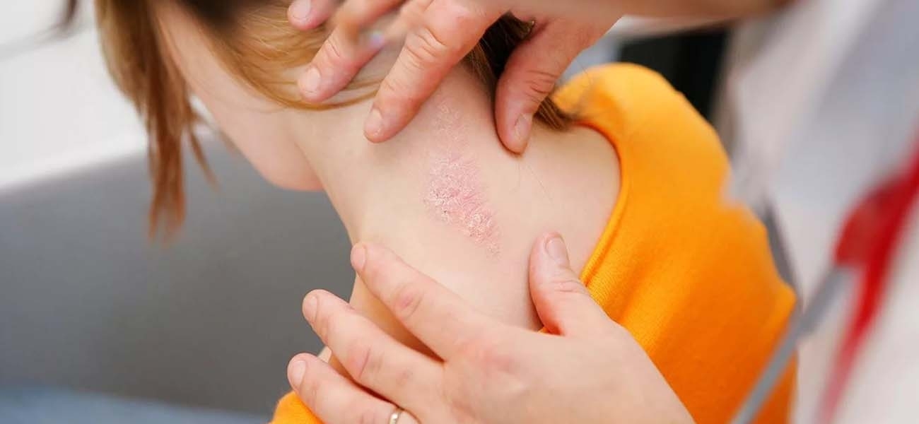 Sedef Hastalığı: Nedir, Belirtileri ve Yönetim Yöntemleri